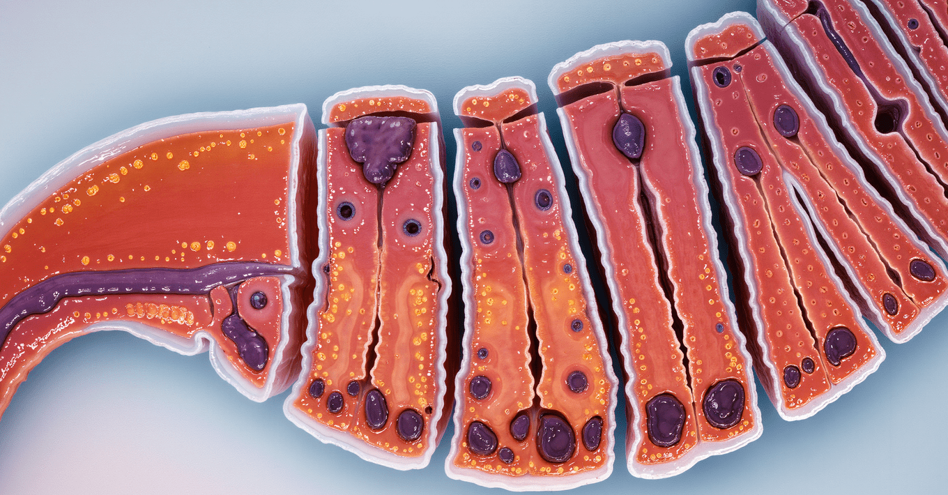 choroba leśniewskiego crohna